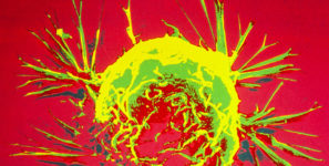 Tumori, arriva una scoperta sensazionale per bloccare le metastasi